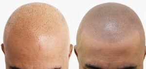 Arikara Mikropigmentacja skóry głowy