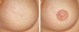 Arikara Mikropigmentacja – Rekonstrukcja brodawki piersiowej